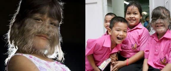 Supattra Sasupan la niña con más pelo del mundo 2 Supattra Sasupan la niña con más pelo del mundo