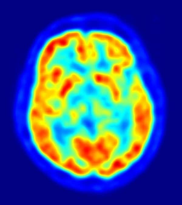 Descubren una variación genética que protege contra el Parkinson 1 Descubren una variación genética que protege contra el Parkinson 2