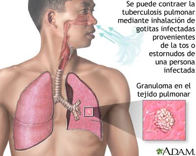 noticias vitamina D  contra la tuberculosis