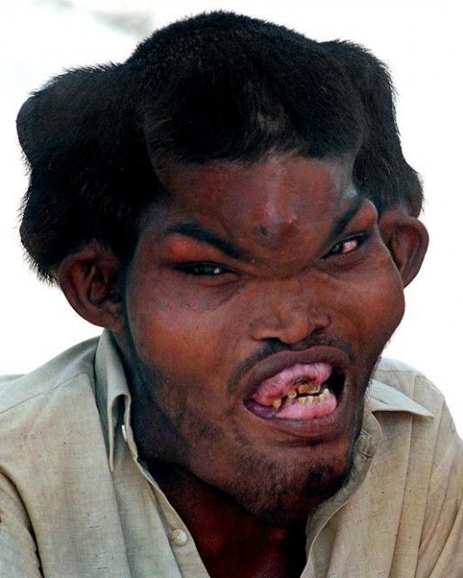 El dramático caso del hombre elefante que quiere ser normal y tener amigos 3 noticias hombre elefante que quiere ser normal y tener amigos