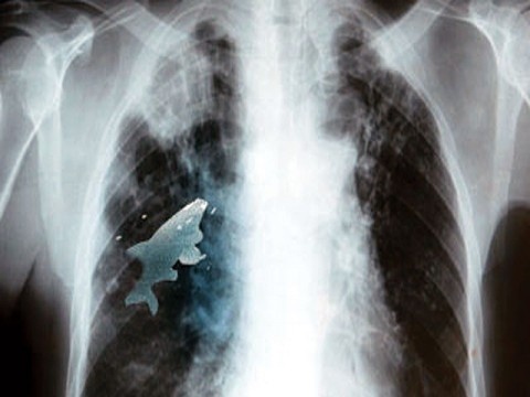 Un pez vivía en el pulmón izquierdo de un niño 1 Un pez vivía en el pulmón izquierdo de un niño 2