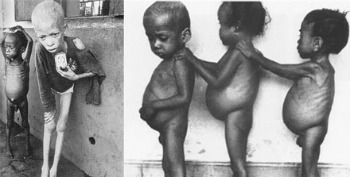 Niños de Biafra apunto de morir de hambre en África