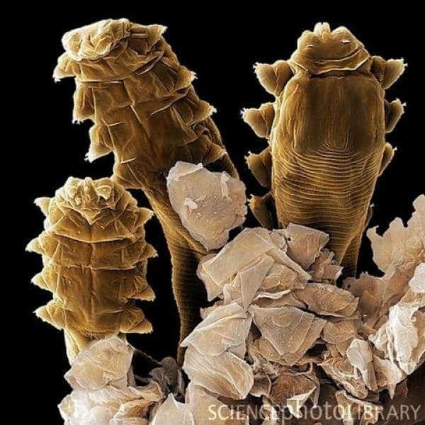 La rosácea podría estar causada por una bacteria presente en la cara 2 noticias La rosácea podría estar causada por una bacteria presente en la cara