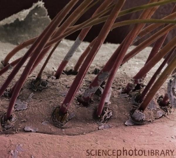 La rosácea podría estar causada por una bacteria presente en la cara 7 noticias La rosácea podría estar causada por una bacteria presente en la cara