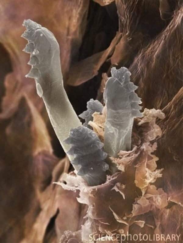La rosácea podría estar causada por una bacteria presente en la cara 8 noticias La rosácea podría estar causada por una bacteria presente en la cara