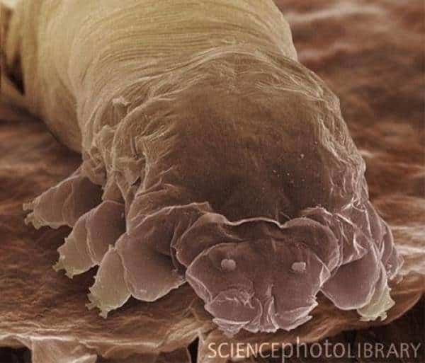La rosácea podría estar causada por una bacteria presente en la cara 10 noticias La rosácea podría estar causada por una bacteria presente en la cara