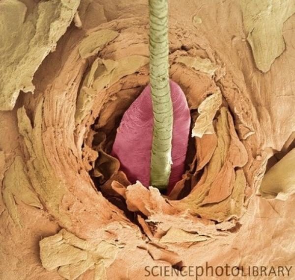La rosácea podría estar causada por una bacteria presente en la cara 5 noticias La rosácea podría estar causada por una bacteria presente en la cara