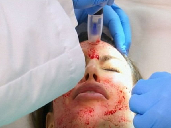 El impactante tratamiento de belleza de Kim Kardashian 5