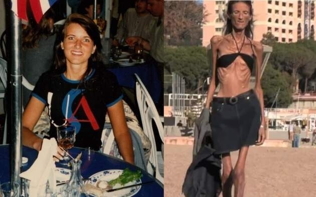 La dura vida de la mujer más anoréxica del mundo 7