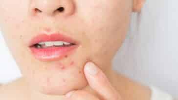 tratamiento para el acne